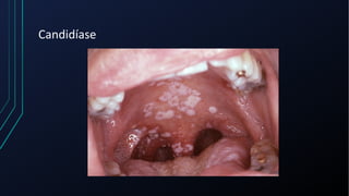 Candidíase
 