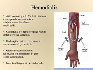Hemodializ
   Arteriovenöz greft :AV fistül açılması
için uygun damar anatomisine
 sahip olmayan hastalarda
 tercih edilir.

  Çoğunlukla Politetrafloroetilen yapıda
sentetik greftler kullanılır.

 Herhangi bir arter ve ven arasına
subcutan olarak yerleştirilir.

  Greft ve subcutan tünelin
adhezyonu için takıldıktan 14 gün
 sonra kullanılabilir.

   İdeal kanülasyon süresi 3-6 haftadır.
 