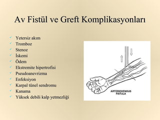 Av Fistül ve Greft Komplikasyonları
   Yetersiz akım
   Tromboz
   Stenoz
   İskemi
   Ödem
   Ekstremite hipertrofisi
   Pseudoanevrizma
   Enfeksiyon
   Karpal tünel sendromu
   Kanama
   Yüksek debili kalp yetmezliği
 