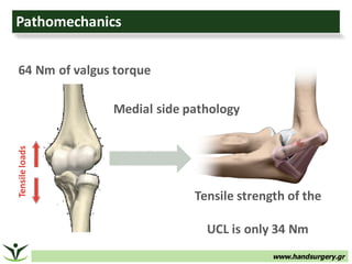 www.handsurgery.gr
PathomechanicsTensile	loads
64	Nm	of	valgus	torque
Tensile	strength	of	the	
UCL	is	only	34	Nm
Medial	side	pathology
 