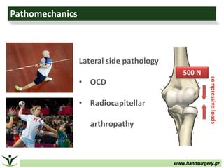 www.handsurgery.gr
Pathomechanics
compressive	loads
Lateral	side	pathology
• OCD
• Radiocapitellar
arthropathy
500	N
 