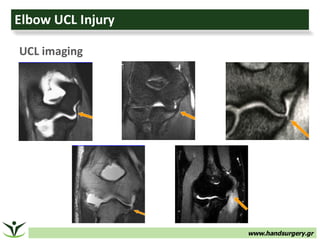 www.handsurgery.gr
Elbow	UCL	Injury
UCL	imaging
 