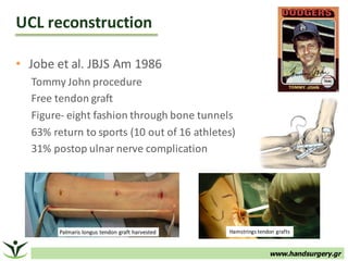 www.handsurgery.gr
• Jobe et	al.	JBJS	Am	1986
Tommy	John	procedure
Free	tendon	graft	
Figure- eight	fashion	through	bone	tunnels
63%	return	to	sports	(10	out	of	16	athletes)
31%	postop	ulnar	nerve	complication
UCL	reconstruction	
Hamstrings	tendon	grafts
 