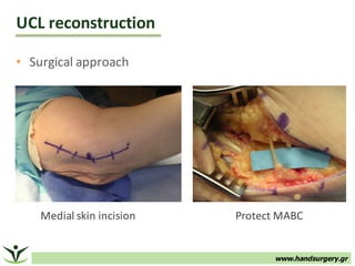 www.handsurgery.gr
• Surgical	approach	
UCL	reconstruction	
Medial	skin	incision Protect	MABC
 