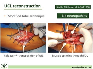 www.handsurgery.gr
• Modified	Jobe Technique
UCL	reconstruction	
Release	+/- transposition	of	UN	 Muscle	splitting	through	FCU
Smith,	Altcheket	al.	AJSM	1996
No	neuropathies	
 