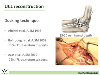 www.handsurgery.gr
Docking	technique
• Altchek et	al.	AJSM	1996
• Rohrboughet	al.	AJSM	2002
95%	(31	pts)	return	to	sports
• Azar et	al.	AJSM	2010
79%	(78	pts)	return	to	sports
UCL	reconstruction	
15-20	mm tunnel	depth
 