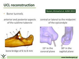 www.handsurgery.gr
• Bone	tunnels
UCL	reconstruction	
central	or	lateral	to	the	midpoint
of	the	epicondyle
30o in	the	
sagittal	plane
15o in	the	
coronal	plane
anterior	and	posterior	aspects	
of	the	sublime	tubercle
Byram,	Ahmad	et	al.	AJSM	2013
bone	bridge	of	6	to	8	mm	
 
