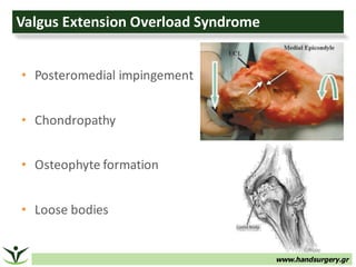 www.handsurgery.gr
Valgus	Extension	Overload	Syndrome
• Posteromedial	impingement
• Chondropathy
• Osteophyte	formation
• Loose	bodies
 