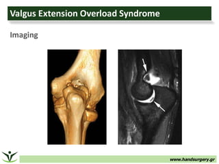 www.handsurgery.gr
Valgus	Extension	Overload	Syndrome
Imaging
 