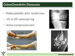 www.handsurgery.gr
OsteoChondritis Dissecans
• Radiocapitellar joint		tenderness
• 15o to	20o extension	lag
• Active	compression	test
 