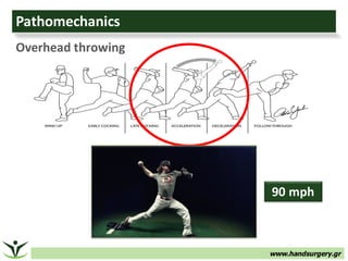 www.handsurgery.gr
Pathomechanics
Overhead	throwing
90	mph
 