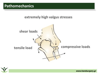 www.handsurgery.gr
Pathomechanics
tensile	loads compressive	loads
shear	loads
extremely	high	valgus	stresses
 