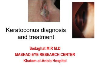 Keratoconus diagnosis and treatment Sedaghat M.R M.D MASHAD EYE RESEARCH CENTER Khatam-al-Anbia Hospital 