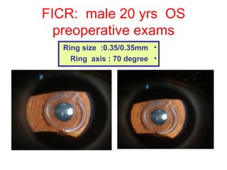 FICR:  male 20 yrs  OS preoperative exams Ring size  :0.35/0.35mm Ring  axis : 70 degree 