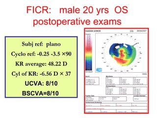 FICR:  male 20 yrs  OS postoperative exams Subj ref:  plano Cyclo ref: -0.25 -3.5  × 90 KR average: 48.22 D Cyl of KR: -6.56 D  ×  37 UCVA: 8/10 BSCVA=8/10   