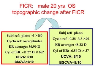 FICR:  male 20 yrs  OS topographic change after FICR   Subj ref:  plano Cyclo ref: -0.25 -3.5  × 90 KR average: 48.22 D Cyl of KR: -6.56 D  ×  37 UCVA: 8/10 BSCVA=8/10   Subj ref:  plano -6  × 160 Cyclo ref: overcylinder KR average: 56.99 D Cyl of KR: -11.27 D  ×  162 UCVA: 3/10 BSCVA=5/10   