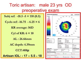 Toric artisan:  male 23 yrs  OD preoperative exam Subj ref:  -18.5 -5  ×  110 (0.5) Cyclo ref: -16.75  - 6.25  ×  6 KR average: 56D Cyl of KR: 6  ×  10 AL : 26.66mm AC depth: 4.39mm CCT:408 μ Artisan IOL: - 17 – 5.5  ×  18 