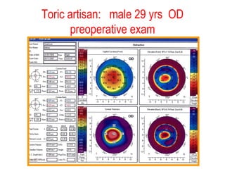 Toric artisan:  male 29 yrs  OD preoperative exam 