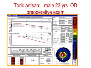 Toric artisan:  male 23 yrs  OD preoperative exam 