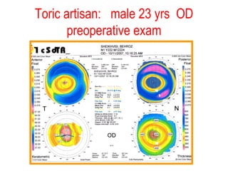 Toric artisan:  male 23 yrs  OD preoperative exam 