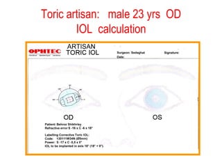 Toric artisan:  male 23 yrs  OD IOL  calculation 