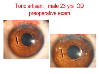Toric artisan:  male 23 yrs  OD preoperative exam 