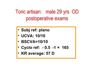 Toric artisan:  male 29 yrs  OD postoperative exams Subj ref: plano UCVA: 10/10 BSCVA=10/10  Cyclo ref:  - 0.5  -1  ×   165 KR average: 57 D 
