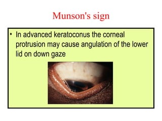 Munson's sign In advanced keratoconus the corneal protrusion may cause angulation of the lower lid on down gaze 