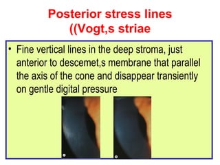 Posterior stress lines (Vogt,s striae) Fine vertical lines in the deep stroma, just anterior to descemet,s membrane that parallel the axis of the cone and disappear transiently on gentle digital pressure 