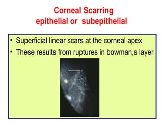 Corneal Scarring  epithelial or  subepithelial Superficial linear scars at the corneal apex These results from ruptures in bowman,s layer 