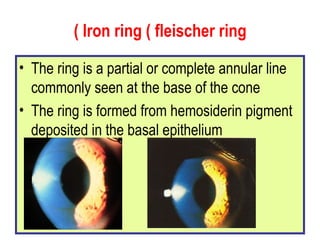 Iron ring ( fleischer ring ) The ring is a partial or complete annular line commonly seen at the base of the cone  The ring is formed from hemosiderin pigment deposited in the basal epithelium 