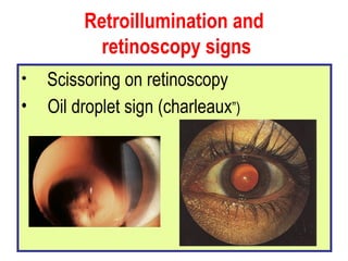 Retroillumination and  retinoscopy signs Scissoring on retinoscopy Oil droplet sign (charleaux ”) 