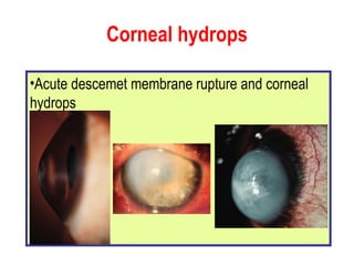 Corneal hydrops Acute descemet membrane rupture and corneal hydrops 