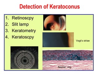 Detection of Keratoconus Retinoscpy Slit lamp  Keratometry Keratoscpy Vogt’s striae fleisher’ ring 