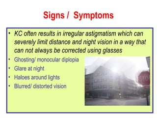 Signs /  Symptoms KC often results in irregular astigmatism which can severely limit distance and night vision in a way that can not always be corrected using glasses Ghosting/ monocular diplopia Glare at night Haloes around lights Blurred/ distorted vision 