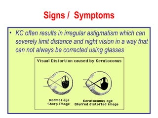 Signs /  Symptoms KC often results in irregular astigmatism which can severely limit distance and night vision in a way that can not always be corrected using glasses 