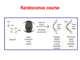Keratoconus course 
