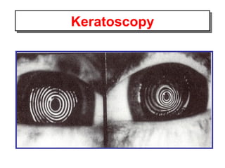 Keratoscopy 