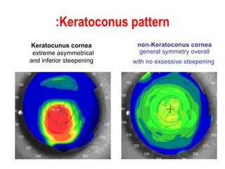 Keratoconus pattern: non-Keratoconus cornea  general symmetry overall with no exsessive steepening   Keratocunus cornea    extreme asymmetrical and inferior steepening   