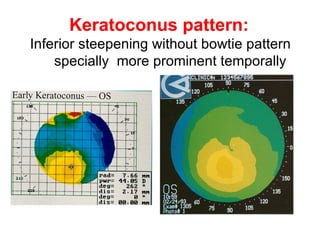 Keratoconus pattern:   Inferior steepening without bowtie pattern   specially  more prominent temporally 