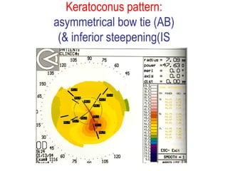 Keratoconus pattern: asymmetrical bow tie (AB) & inferior steepening(IS) 