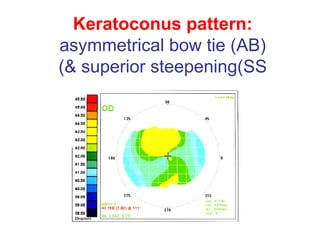 Keratoconus pattern: asymmetrical bow tie (AB) & superior steepening(SS) 