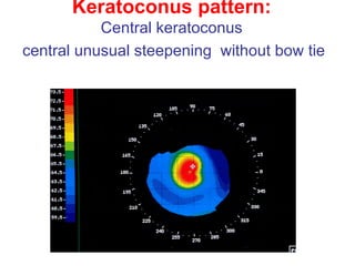 Keratoconus pattern: Central keratoconus  central unusual steepening  without bow tie   