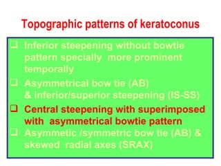 Topographic patterns of keratoconus Inferior steepening without bowtie pattern specially  more prominent temporally Asymmetrical bow tie (AB) & inferior/superior steepening (IS-SS) Central steepening with superimposed with  asymmetrical bowtie pattern Asymmetic /symmetric bow tie (AB) &  skewed  radial axes (SRAX) 