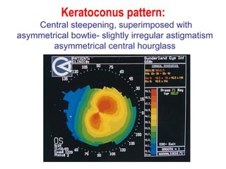 Keratoconus pattern:   Central steepening, superimposed with  asymmetrical bowtie- slightly irregular astigmatism asymmetrical central hourglass 