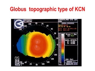 Globus  topographic type of KCN 