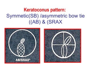 Keratoconus pattern:   Symmetic(SB) /asymmetric bow tie (AB) & (SRAX) 