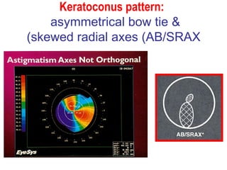Keratoconus pattern:   asymmetrical bow tie &  skewed radial axes (AB/SRAX) 
