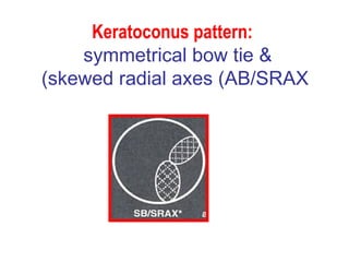 Keratoconus pattern:   symmetrical bow tie &  skewed radial axes (AB/SRAX) 