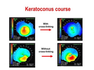 Keratoconus course   With  cross-linking Without  cross-linking 